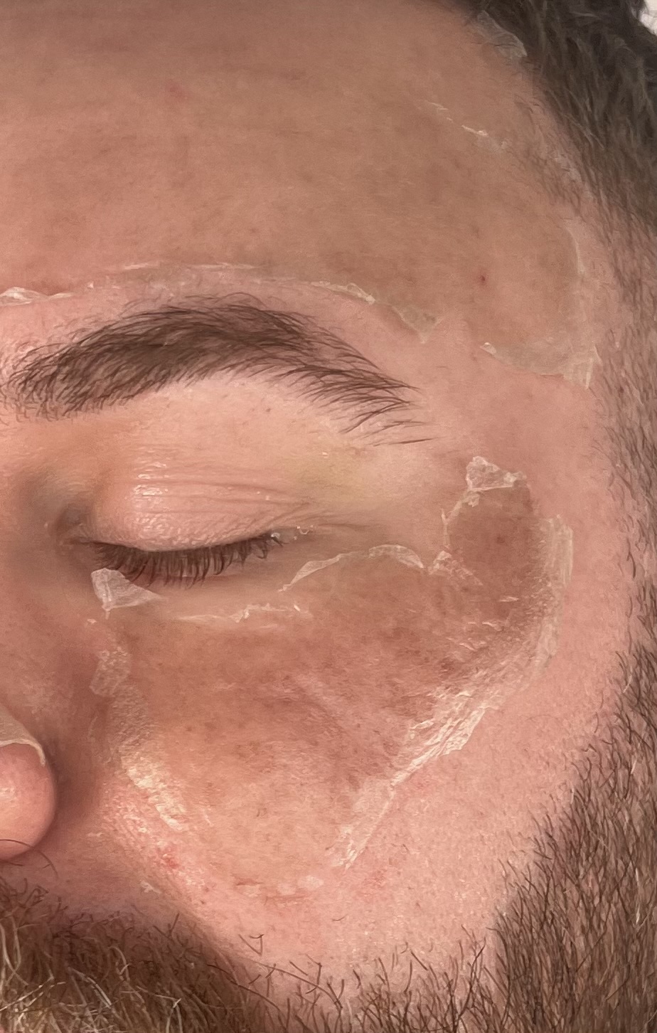 Close-up of peeling skin on the temple and cheek during TCA recovery.