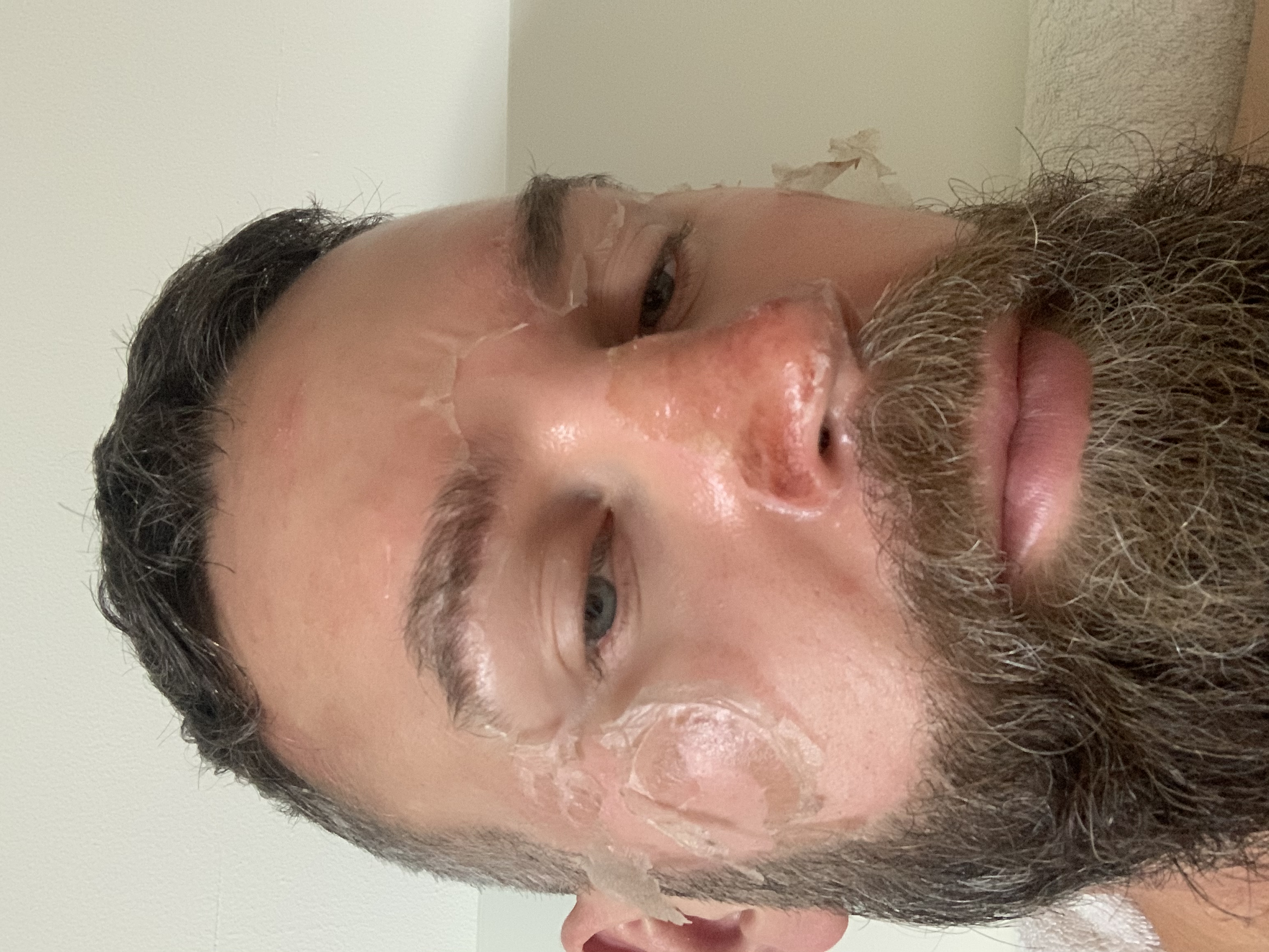 Close-up of the nose and cheek showing peeling skin during TCA recovery.